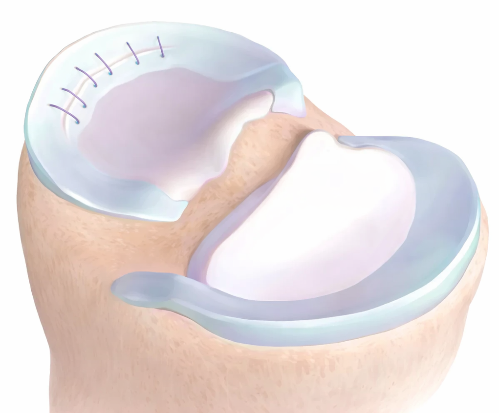 menisküs yırtığı tedavisi